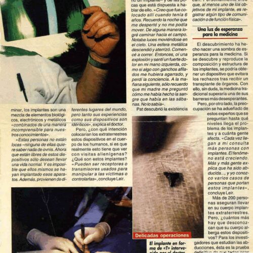 Abducciones e implantes - Imagen 1